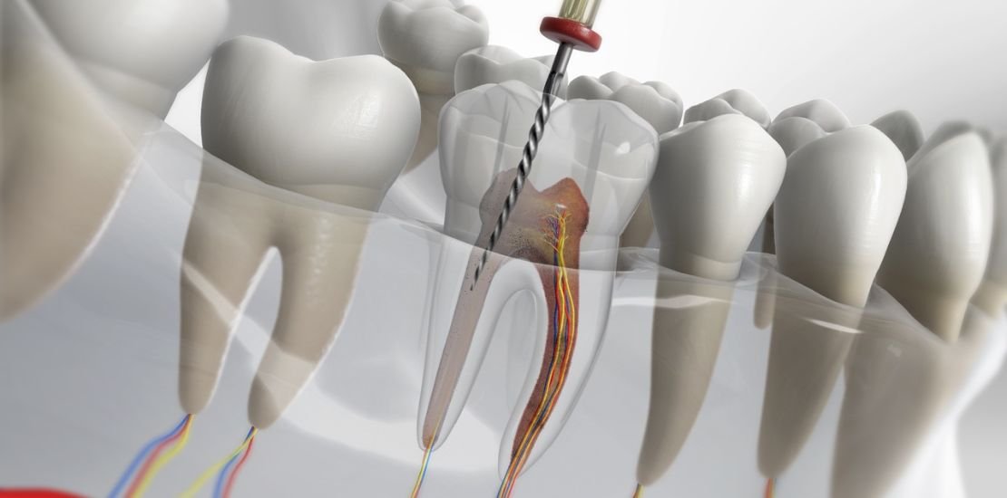 Single Sitting Root Canal